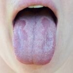 Quels sont les causes et les traitements de la langue blanche ?