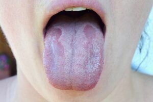 Quels sont les causes et les traitements de la langue blanche ?